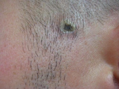 Is it safe to pull off a skin mole?