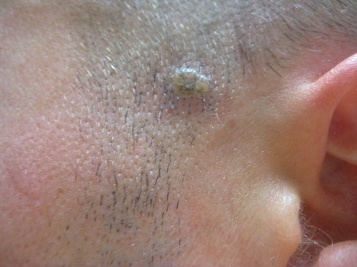 Remove moles in less than a week with this simple tip! Ugly moles will go away and stay away!