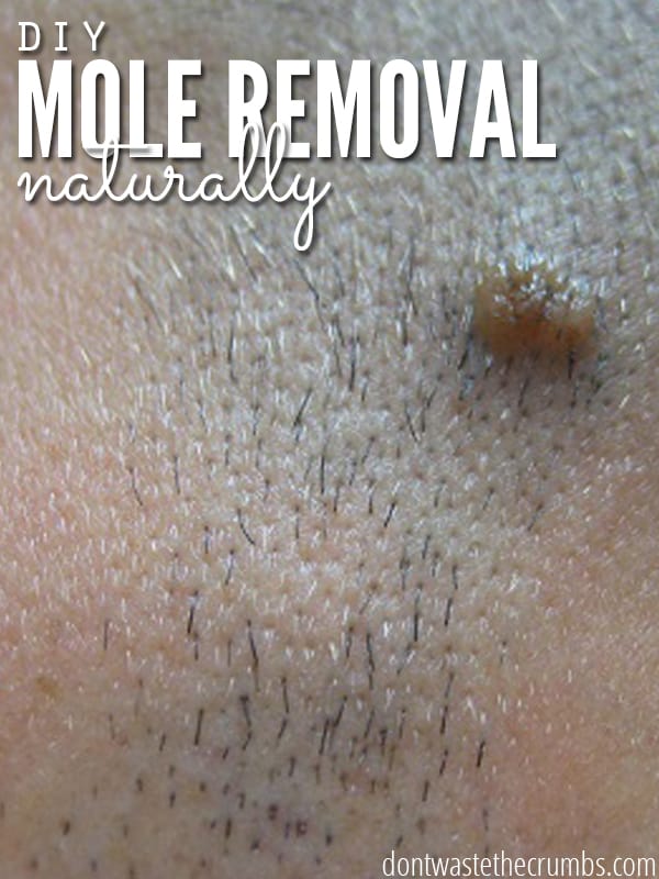 Apple cider vinegar mole removal tutorial with pictures and follow-up photos. A safe method without side effects and reviews showing it works with no scars! :: DontWastethCrumbs.com